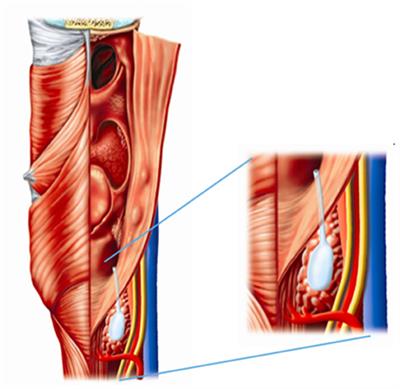 Fourth Branchial Anomalies: Diagnosis, Treatment, and Long-Term Outcome